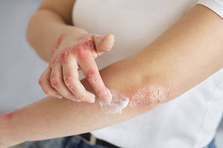 Cerca de 3 millones de mexicanos tienen psoriasis