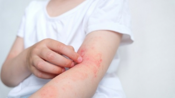 Lanzan plataforma digital educativa para personas que viven con dermatitis atópica