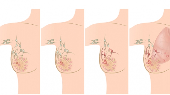 Desde la detección al tratamiento del cáncer de mama